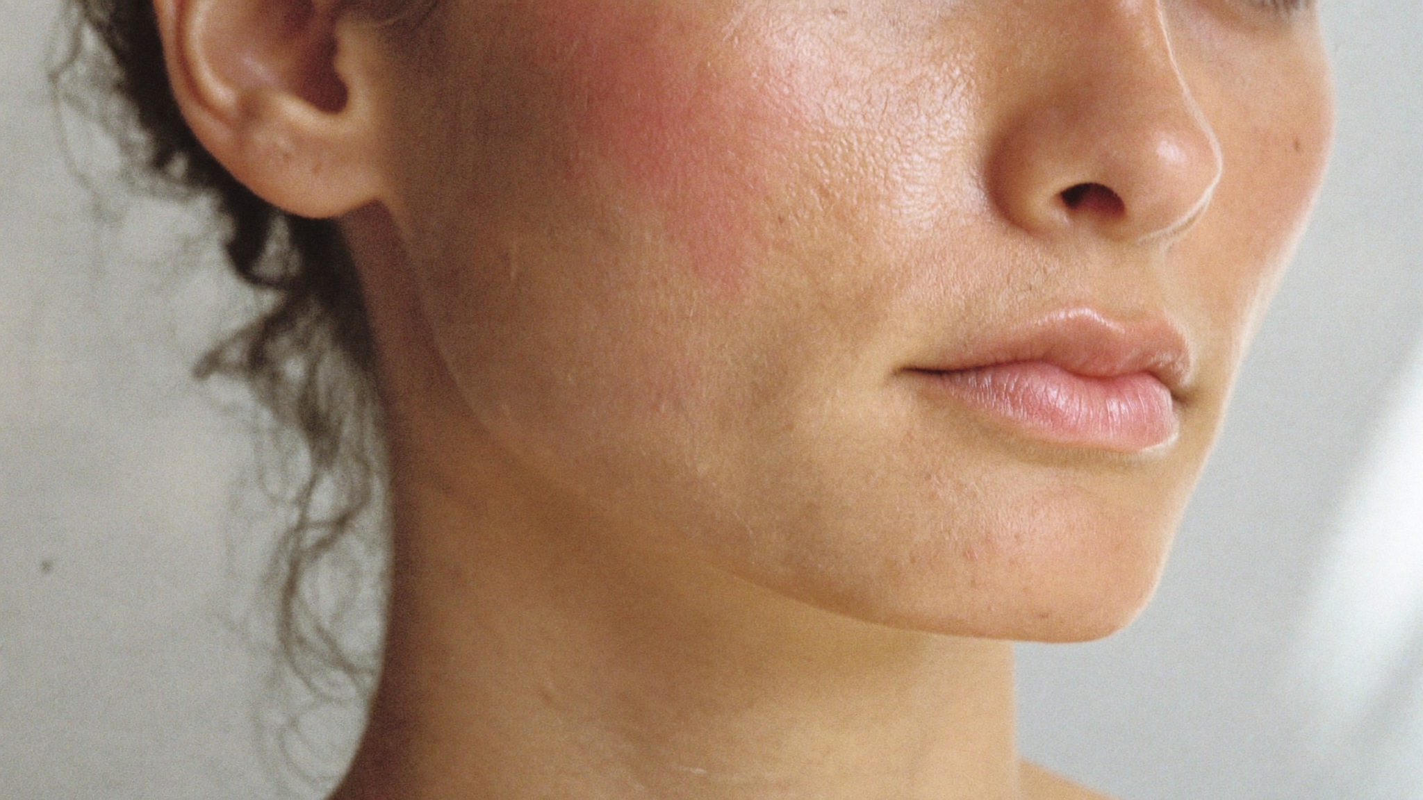 Picture of Lady with Slight Redness on Upper Chin